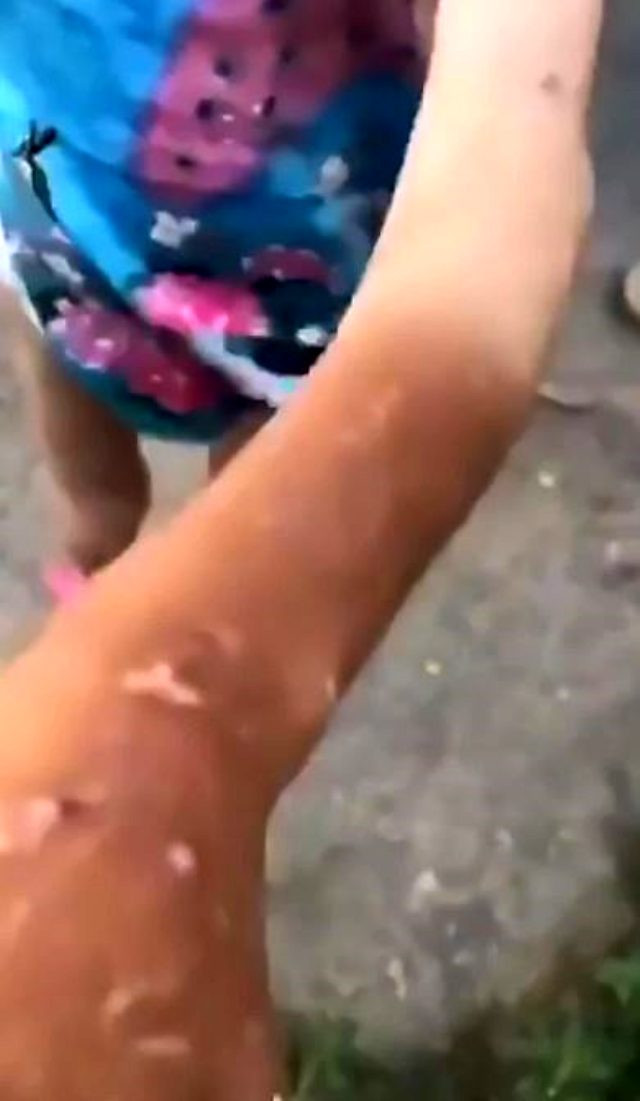 Nənənin nəvəsinə qarşı DƏHŞƏTLİ ƏMƏLİ - Ətini kəlbətinlə qopardı  (FOTO+VİDEO)